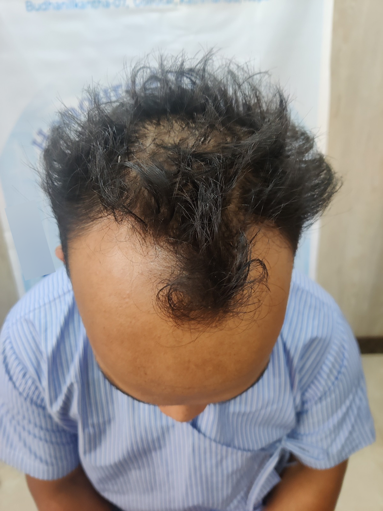 Hair transplant 2 before