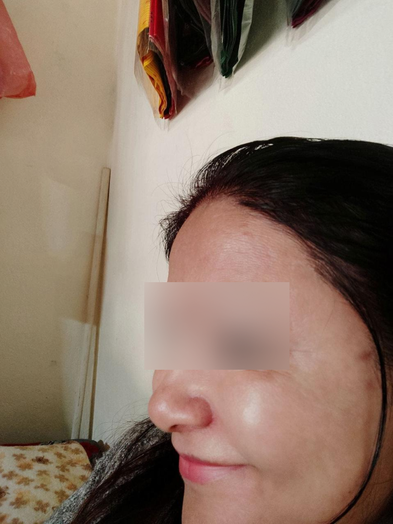botox after
