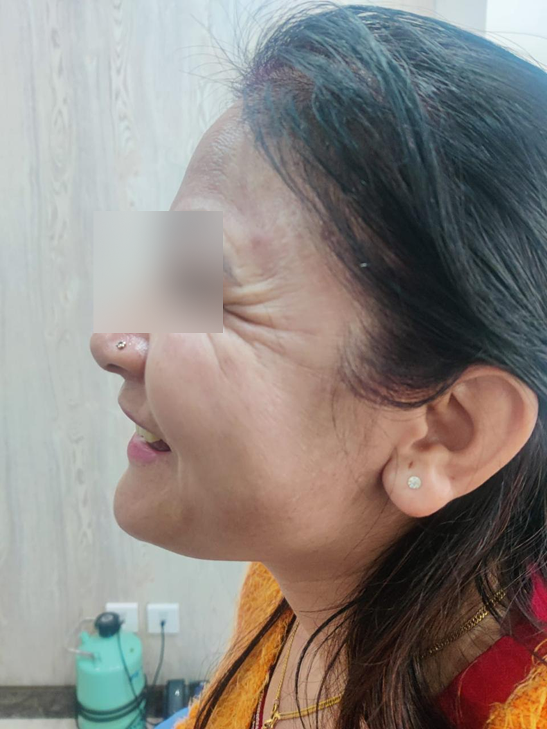 botox before