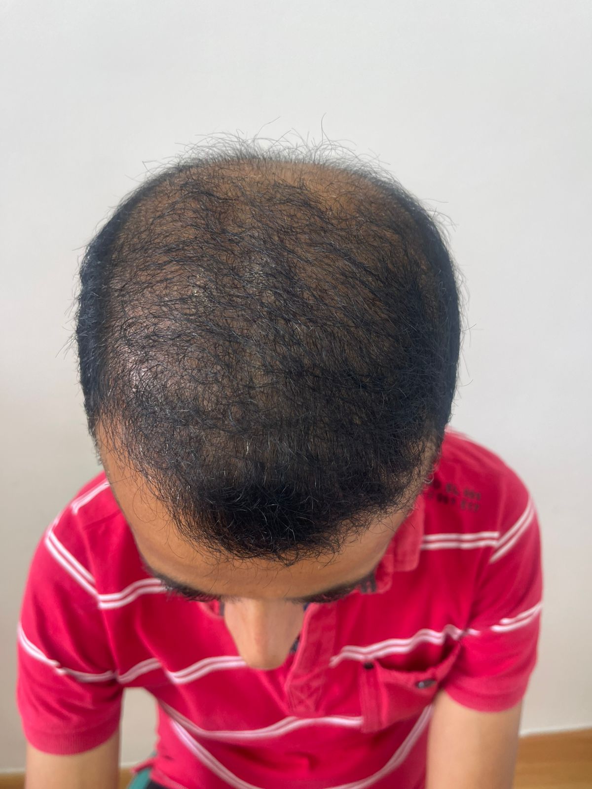 Hair transplant 1 after