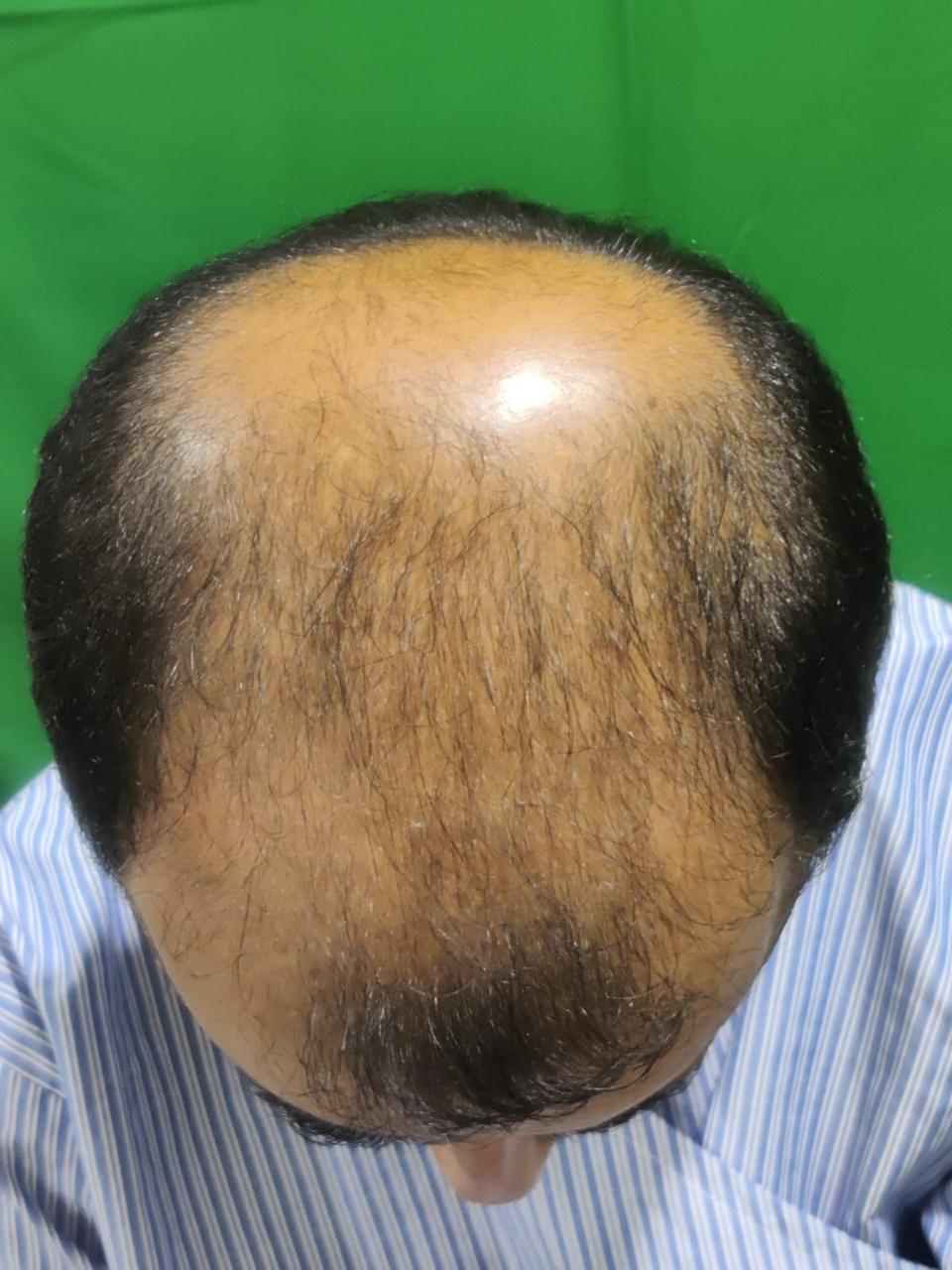 Hair transplant 1 before