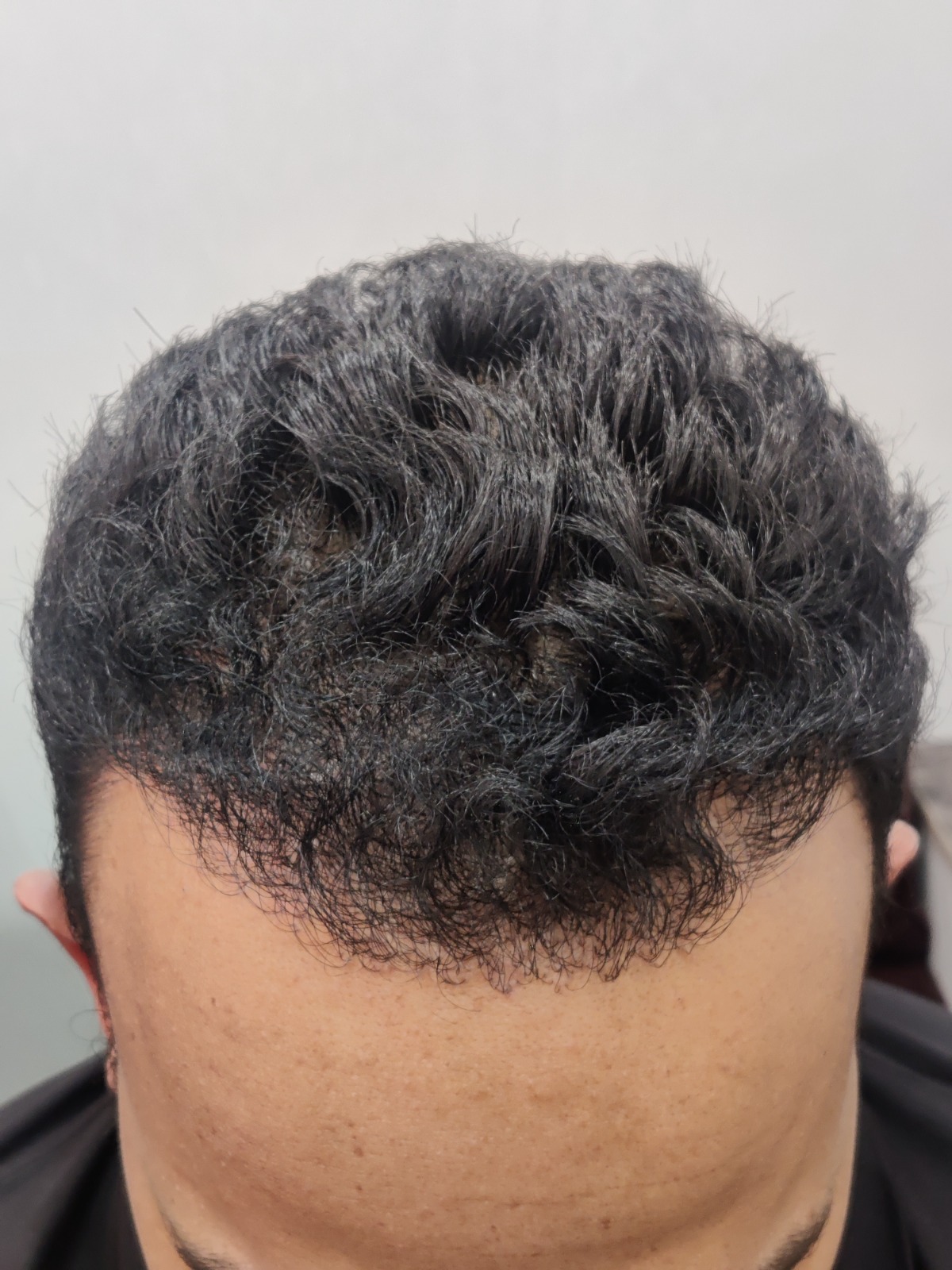Hair transplant 2 after