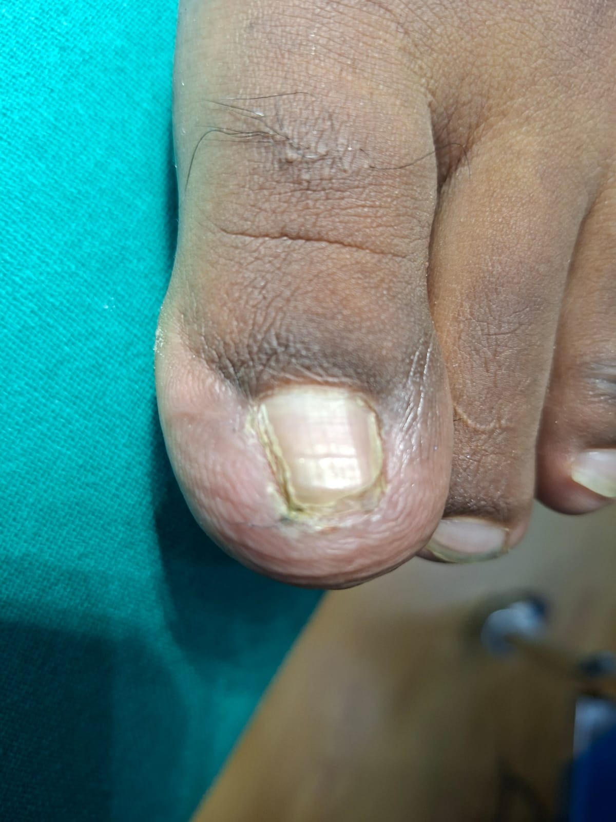 botox after
