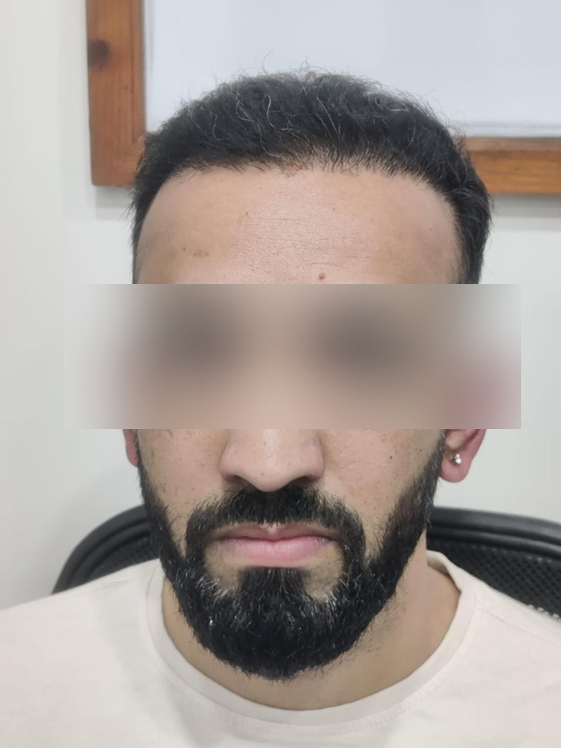 Hair transplant 3 after