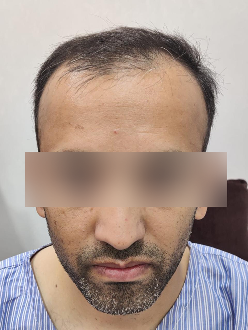 Hair transplant 3 before